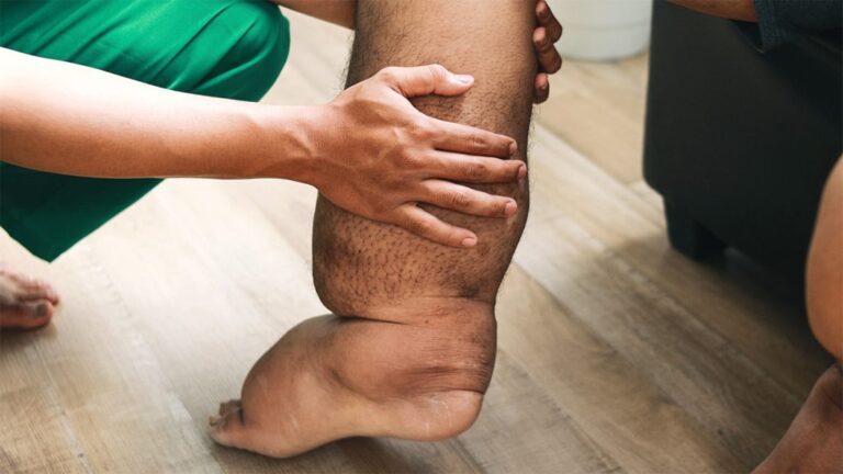 Filaria-Hattipaile-1024x576