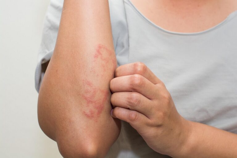 Eczema_Skin_