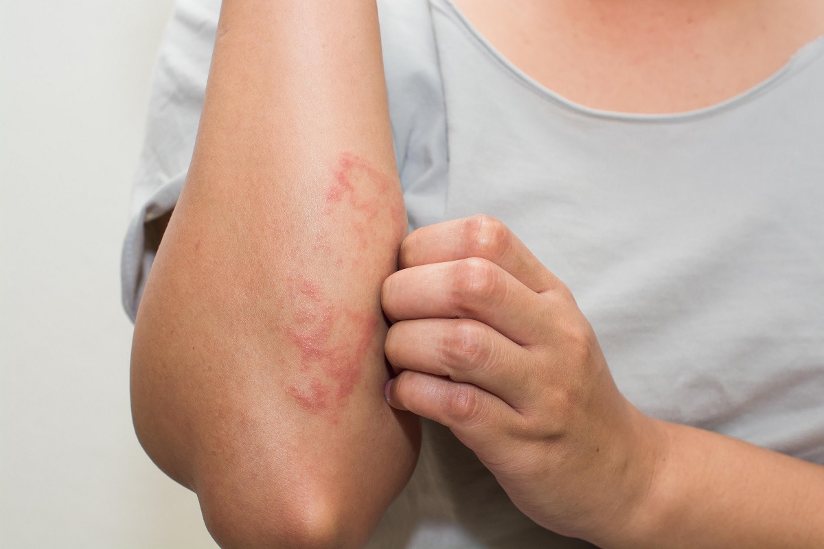 Eczema_Skin_